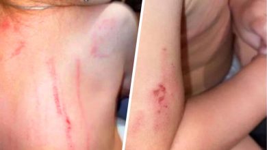 Фото - В Бурятии родители обнаружили жуткие царапины и укусы на теле дочери после посещения детского сада